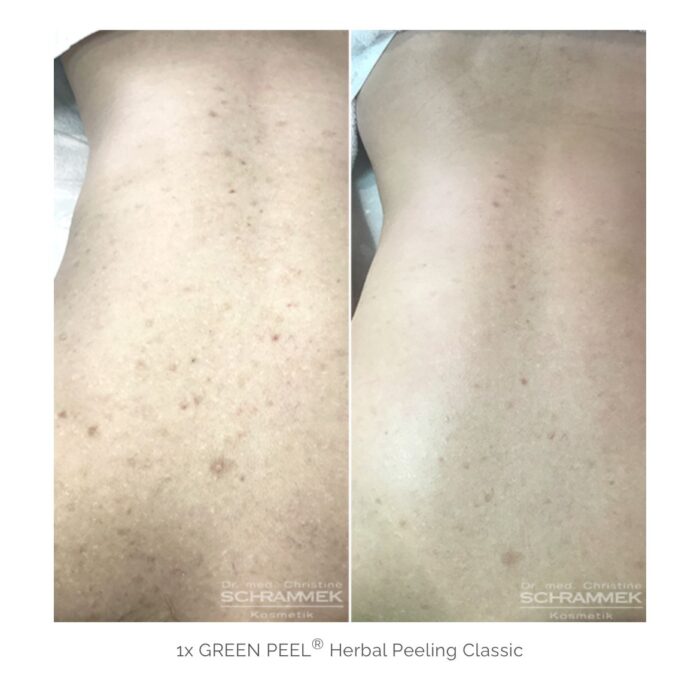 Herbal Peeling Classic (espalda)