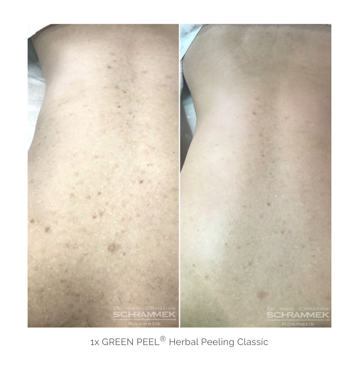 Herbal Peeling Classic (espalda)