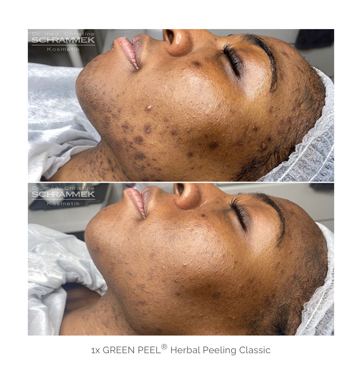 Herbal Peeling Classic